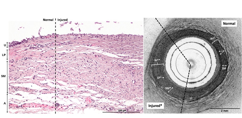Ureteral electrothermal injury, characterized by damaged collagen bundles, with swelling and fragmentation of smooth muscle fibers