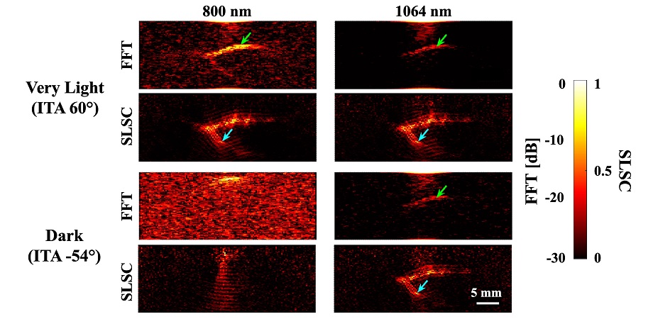 Photoacoustic images of a splayed vessel structure underlying very light and dark skin tones