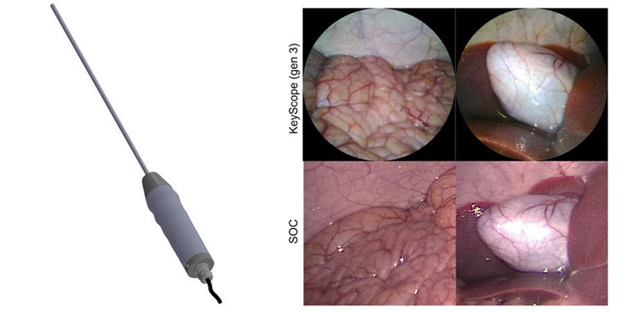 Low-cost laparoscope, called the KeyScope 