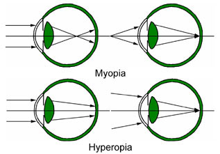 Myopia and Hyperopia