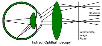 Indirect Ophthalmoscopy